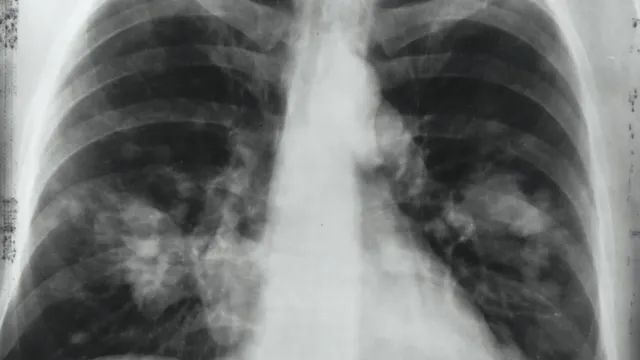 https://www.completeasbestossurveys.co.uk/wp-content/uploads/2023/10/Asbestos-related-lung-cancer-1-1920x1957.jpg