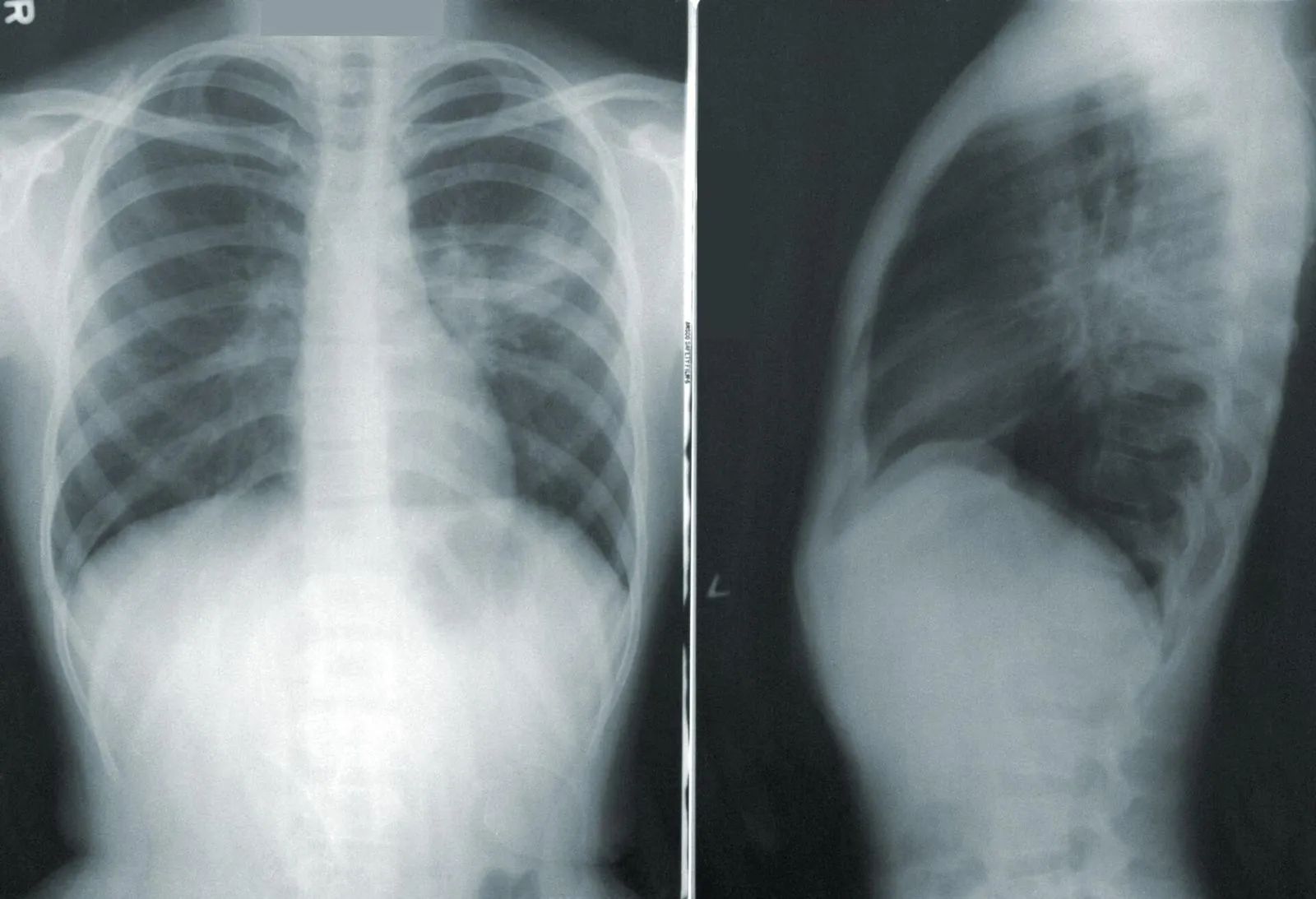 X-Ray of asbestosis