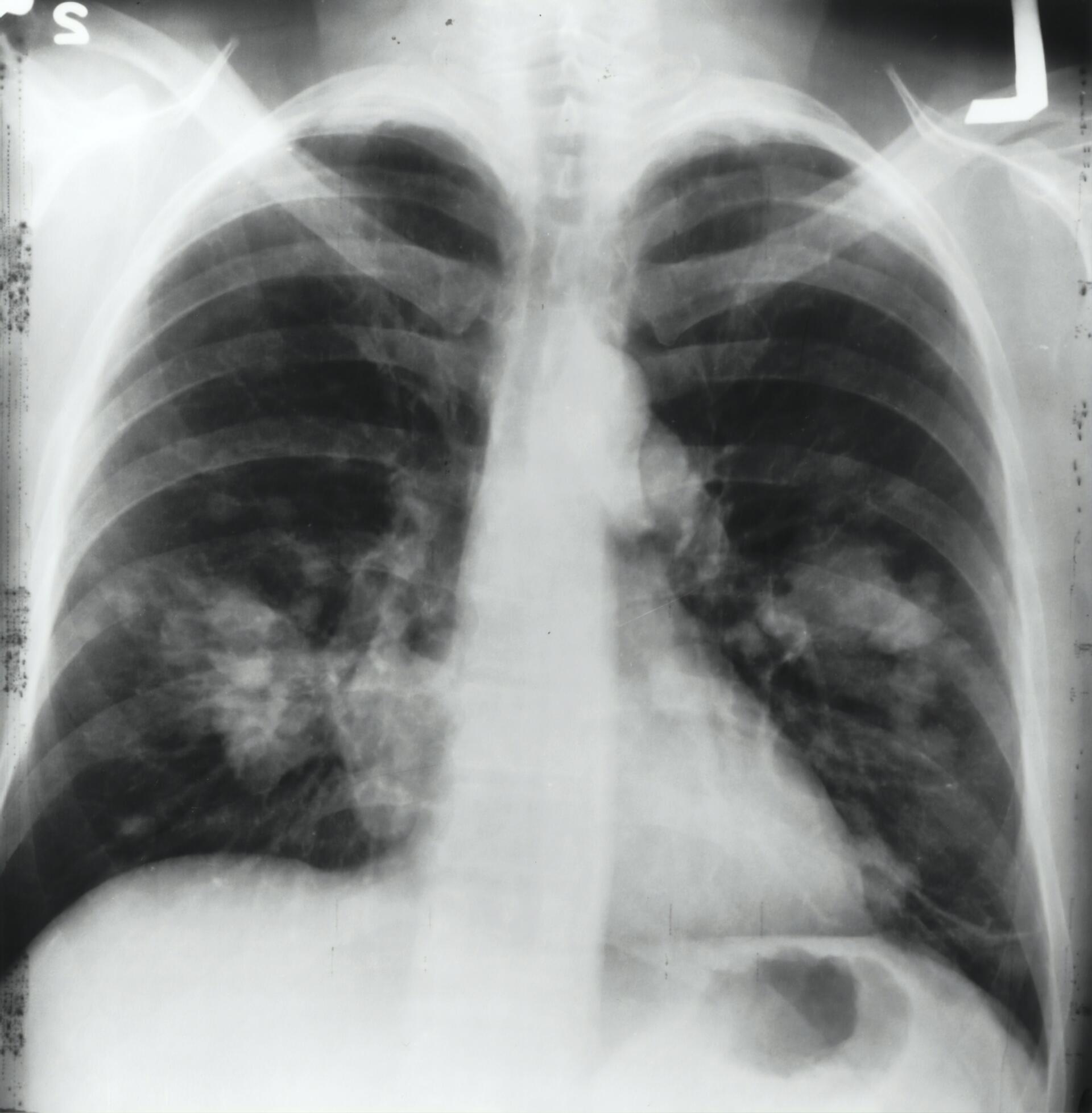 Asbestos related lung cancer